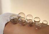 cupping